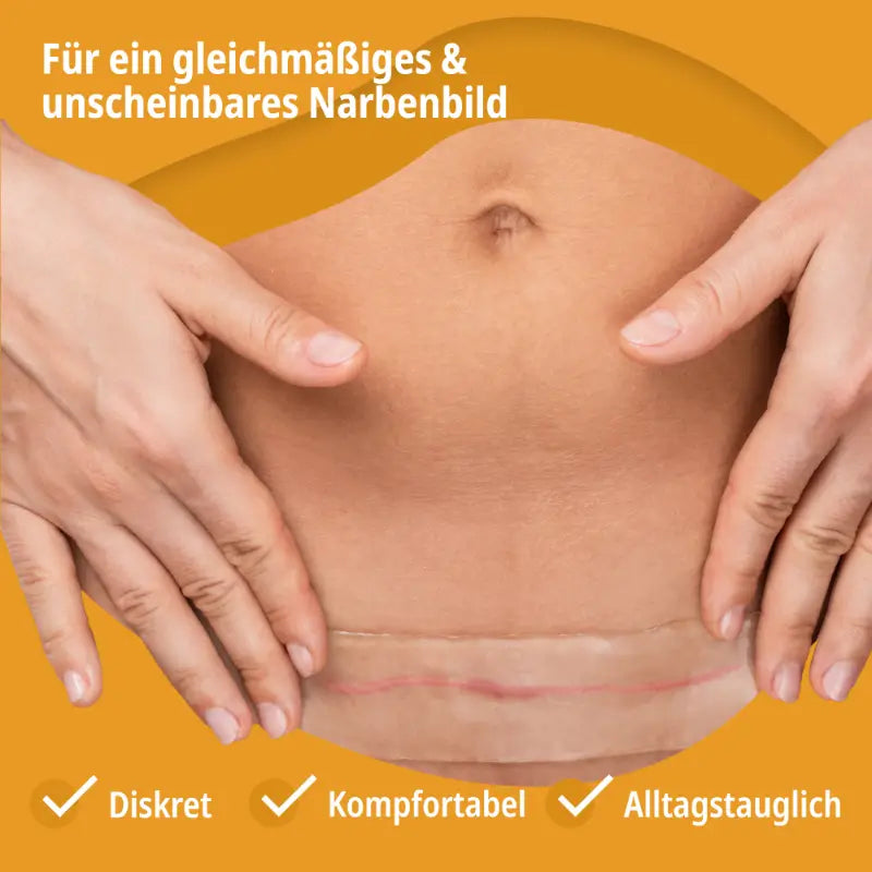 Evolsin Narbenpflaster zur Behandlung einer verheilten Kaiserschnittnarbe