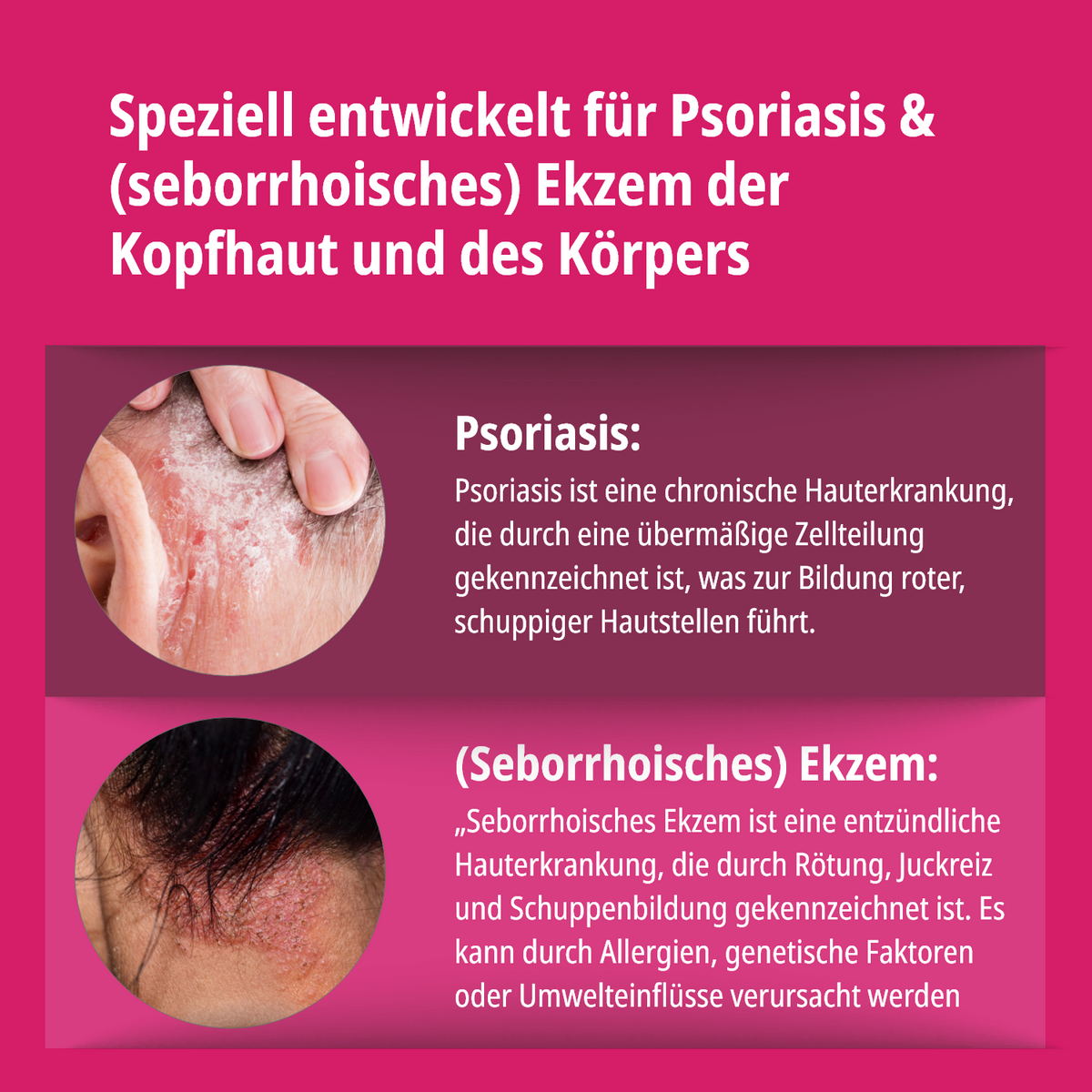 Psoriasis & Ekzem Lotion für Kopfhaut und Körper