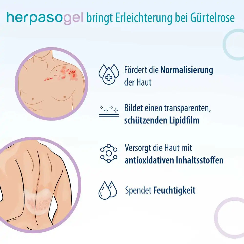 Herpasogel bei Gürterose