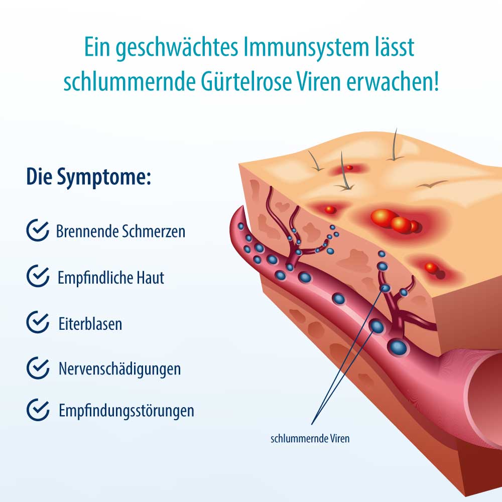 Herpasogel bei Gürterose