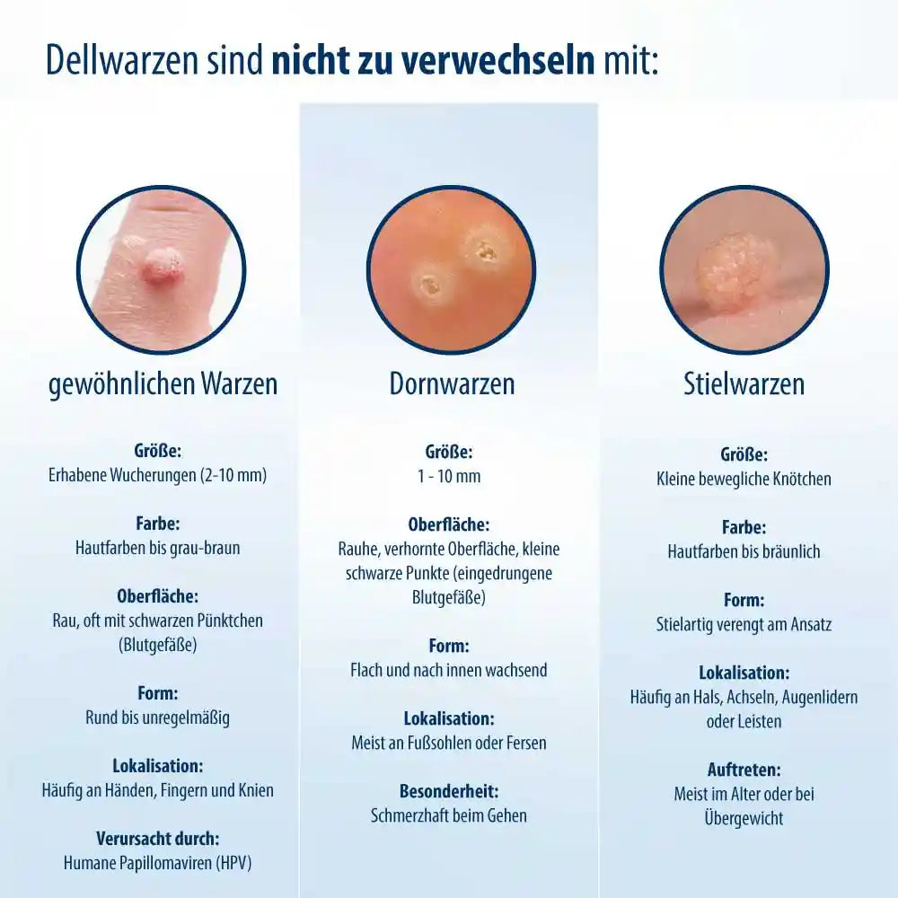 Dellwarzen Mittel