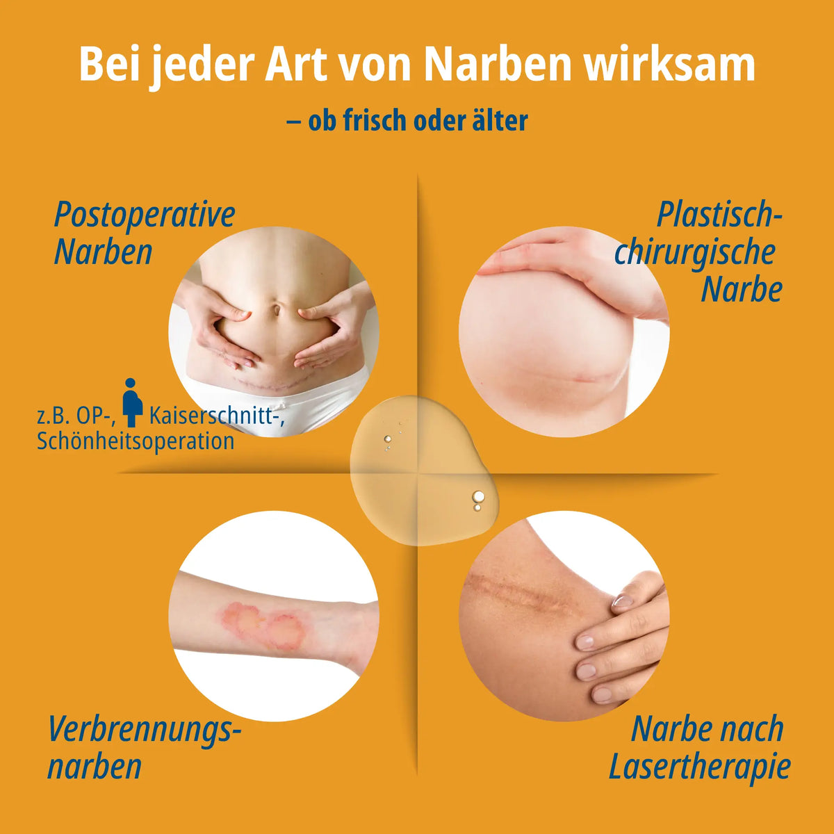 Evolsin Narben-Gel 20g für Kinder & Erwachsene