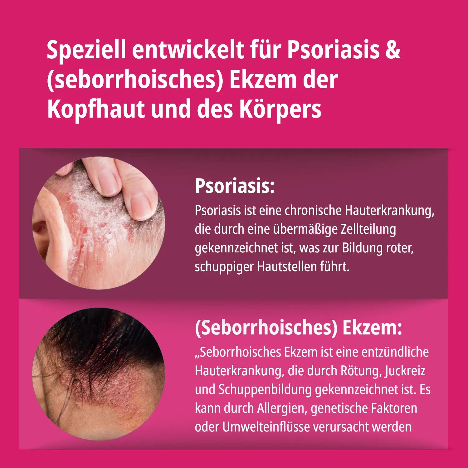Psoriasis & Ekzem Kopfhaut & Haut Set – Lotion & Shampoo