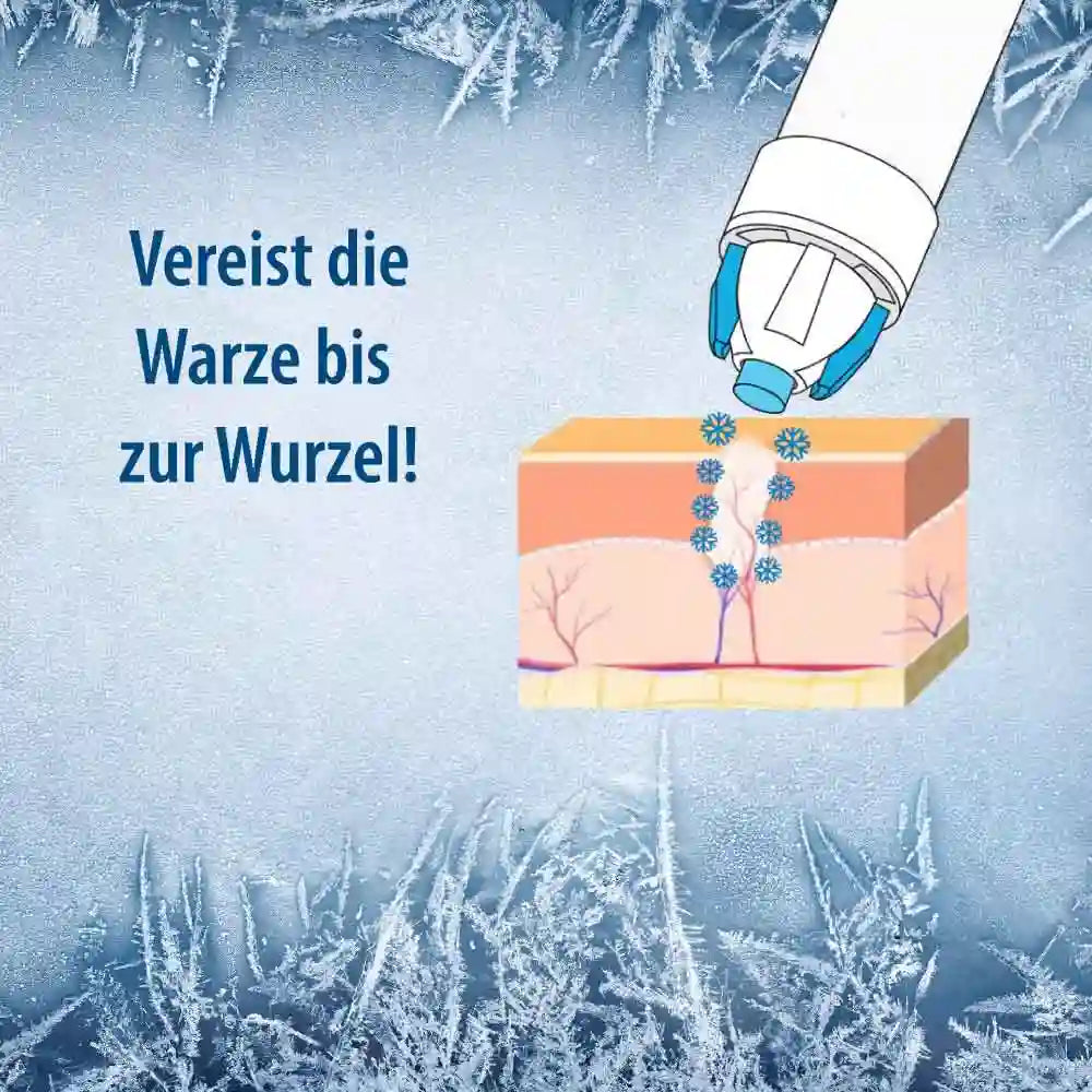 Warzenvereiser Spray